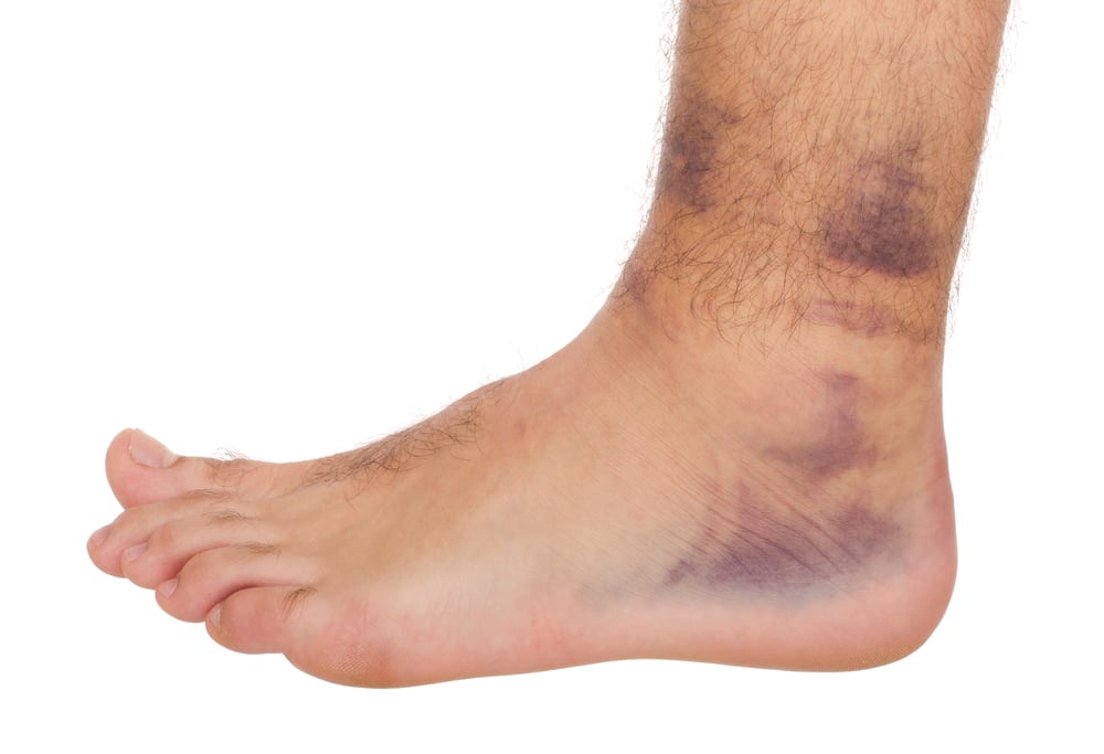 a swollen foot and ankle with visible purple bruising
